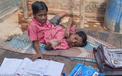 Ấn Độ: Cặp song sinh dính liền thắt lưng không muốn tách rời