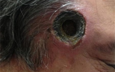 Người đàn ông thủng đầu vì thuốc tẩy nốt ruồi