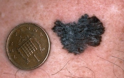 Tỉ lệ đồng trong máu liên quan đến ung thư