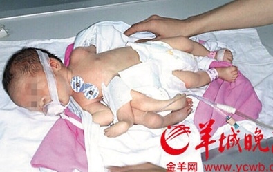 Trung Quốc: Phẫu thuật bỏ chi thừa cho bé sơ sinh 8 chi