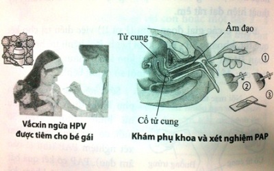 Cấp bách vấn đề dự phòng - điều trị ung thư cổ tử cung