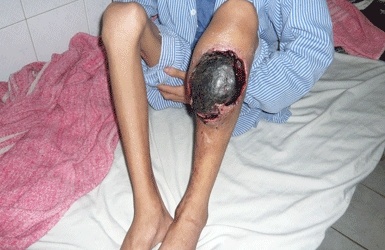 Hơn 6.000 người Việt mắc 'căn bệnh hoàng gia'