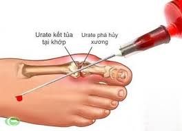 Tác dụng phụ của thuốc chữa gút