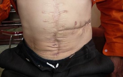 Mổ 6 lần trong 8 năm, vẫn không tìm ra đúng bệnh