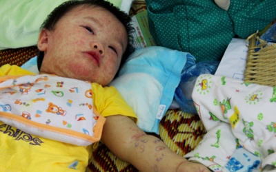 Sở Giáo dục Hà Nội yêu cầu phòng sởi khẩn cấp trong trường học