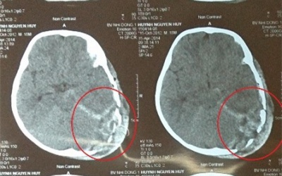 Bé 18 tháng tử vong vì bị tivi đè