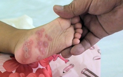 Ninh Thuận: Gia tăng các ca tay, chân, miệng