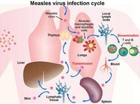 Dự phòng sau phơi nhiễm sởi