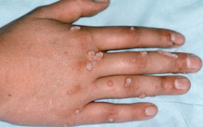 Trị mụn cơm, thuốc nào tốt?