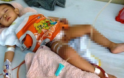 Cần tái tạo gấp bàng quang cho bé Anh Đức