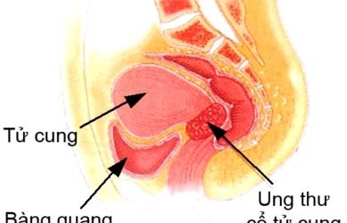 Mỗi ngày, 7 phụ nữ chết vì ung thư cổ tử cung