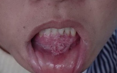 Tránh bệnh sùi mào gà tái phát