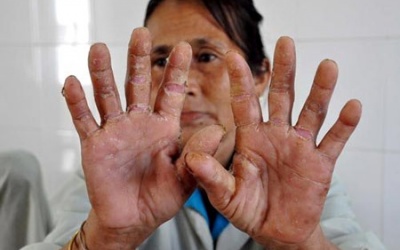 Quảng Ngãi: Bệnh viêm da dày sừng lan sang xã mới