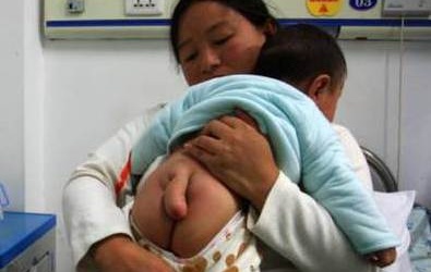 Trung Quốc: Bé 5 tháng tuổi có 'đuôi' dài 13 cm