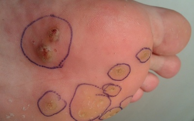 Cách nào hạn chế tái phát chai chân?