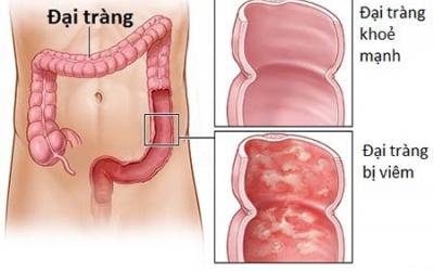 Có nên dùng TPCN để hỗ trợ điều trị viêm đại tràng?