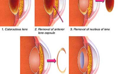 Vỡ thủy tinh thể vì bị bạn học dùng kéo đâm mắt