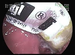 Một bệnh nhân suýt thủng ruột do uống thuốc còn nguyên vỉ