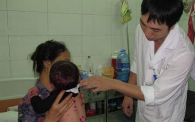 Hà Nội: Số ca mắc thủy đậu đột ngột tăng cao