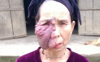 Nửa thế kỉ mang chiếc bướu ở mặt