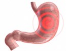 13 dấu hiệu viêm dạ dày