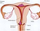 Những bệnh ung thư phụ khoa đáng sợ nhất
