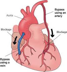 Nguy cơ biến chứng tim mạch do Ðái tháo đường