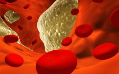 Cholesterol khiến tế bào ung thư di căn nhanh chóng
