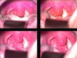 Trẻ viêm VA có nguy hiểm không?