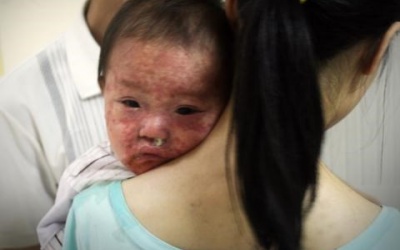 Ngày cuối tuần: 43 trẻ nhỏ mắc sởi