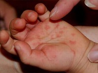 Dấu hiệu nhận biết bệnh tay - chân - miệng