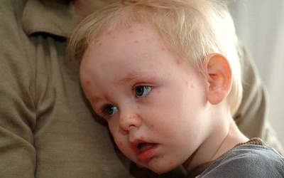 Thiếu vaccine ngừa thủy đậu: Tại sao?