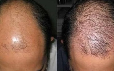 Chữa hói đầu, thuốc nào hiệu quả?