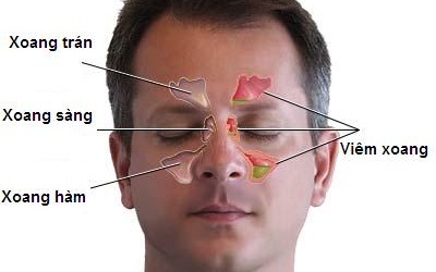 Biến chứng của viêm xoang?