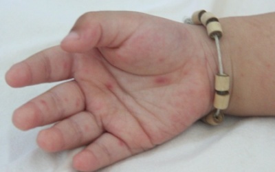 Nhận biết và chăm sóc trẻ tay chân miệng