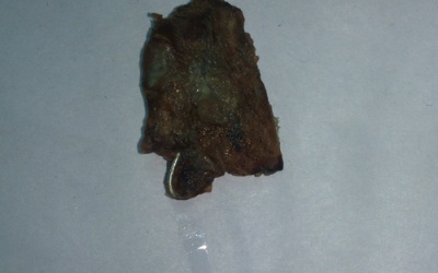 Tìm thất khung răng giả sau 20 năm nằm trong phế quản