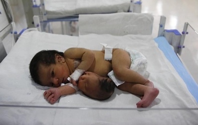 Đầu mọc từ bụng bé sơ sinh