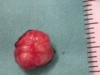 Tăng 30kg trong 2 tháng vì u tụy nội tiết