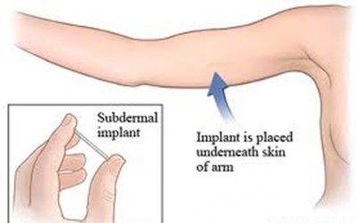 Người bị ung thư vú không nên dùng que cấy tránh thai?