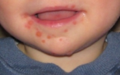 Trẻ có thế nhiều lần bị tay, chân, miệng