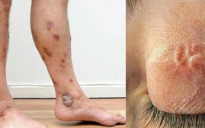 Vướng bệnh vì lười vệ sinh cá nhân