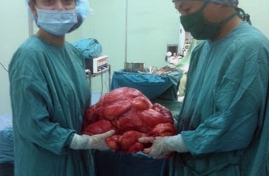 Phẫu thuật lấy khối u 11kg trong ổ bụng bệnh nhân