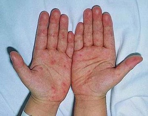 Cứu sống bệnh nhi bị bệnh tay chân miệng nặng