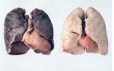 Ung thư phổi: Phát hiện muộn, tử vong nhanh