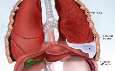 Tràn dịch màng phổi: Gánh nặng sức khỏe và kinh tế