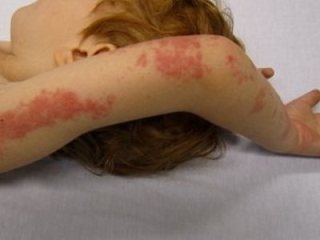 Bệnh giời leo do virus thủy đậu