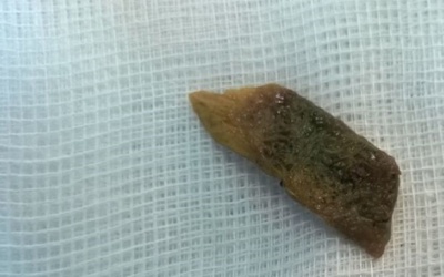 Nuốt xương lợn, áp xe hậu môn