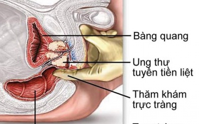 Ai nên cắt bao quy đầu ngừa ung thư?