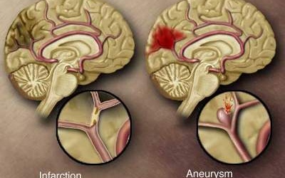 Phòng tránh xuất huyết não