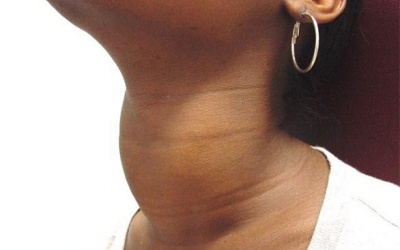 Một số bài thuốc trị bướu cổ do rối loạn tuyến giáp